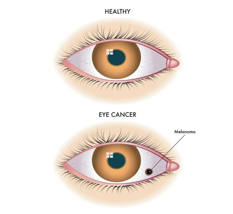 Penyebab Pria Medan Angkat Bola Mata gegara Kena Kanker